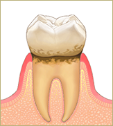 「歯肉炎」
