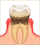 「軽度歯周炎」