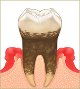 「中度歯周炎」