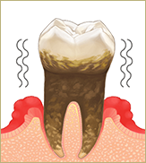 「重度の歯周炎」
